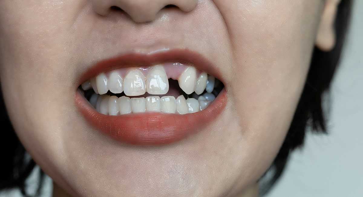 Why You’re Missing Permanent Teeth: Hypodontia article description 