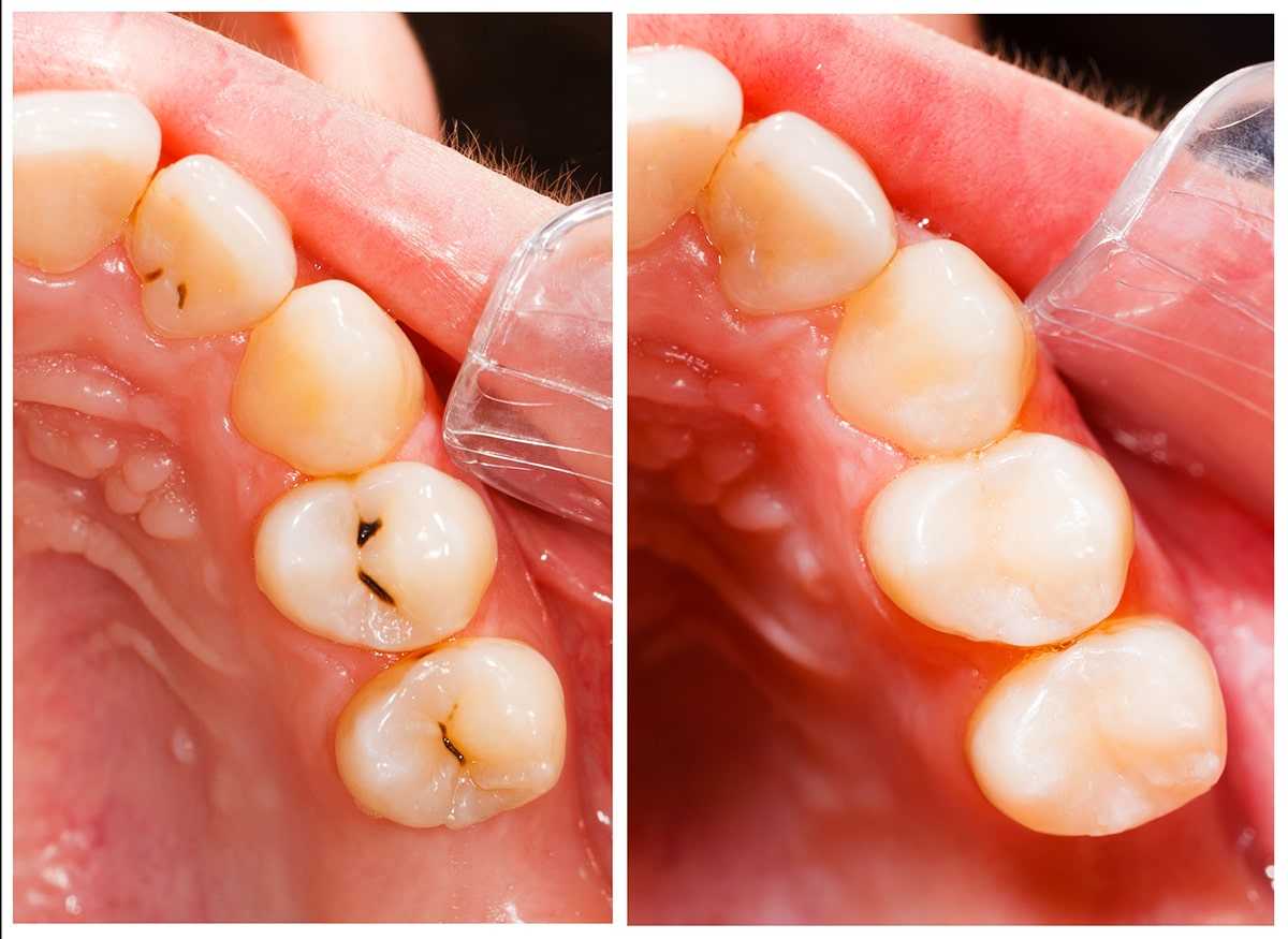 Regrowing vs. Remineralizing Tooth Enamel