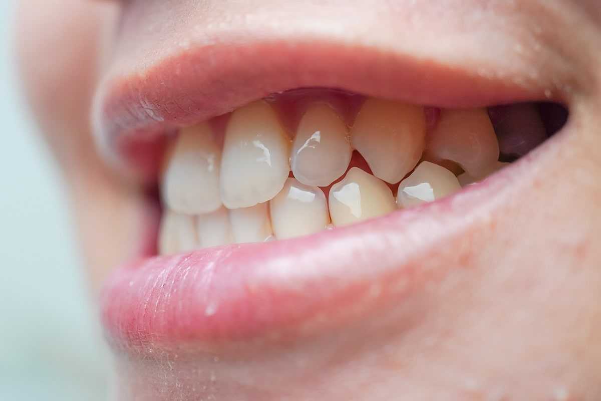 Understanding "Soft Teeth": What You Need to Know article description 