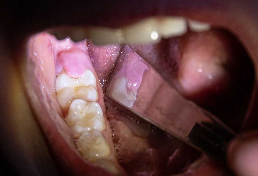 Gum Flap Over Wisdom Tooth? Everything You Need To Know