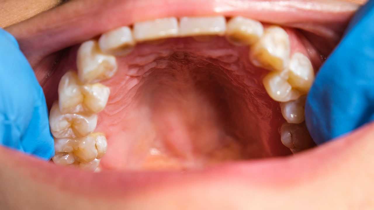 How To Heal a Cut on the Roof of Your Mouth Fast