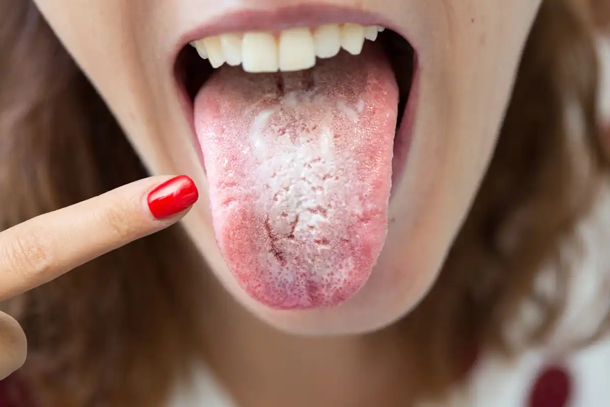 Can You Get A Yeast Infection In Your Mouth? | Oral Thrush