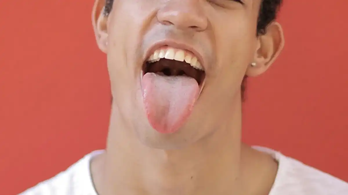 mild fissured tongue