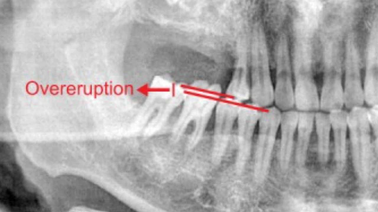 What is “Super-Eruption” Tooth?