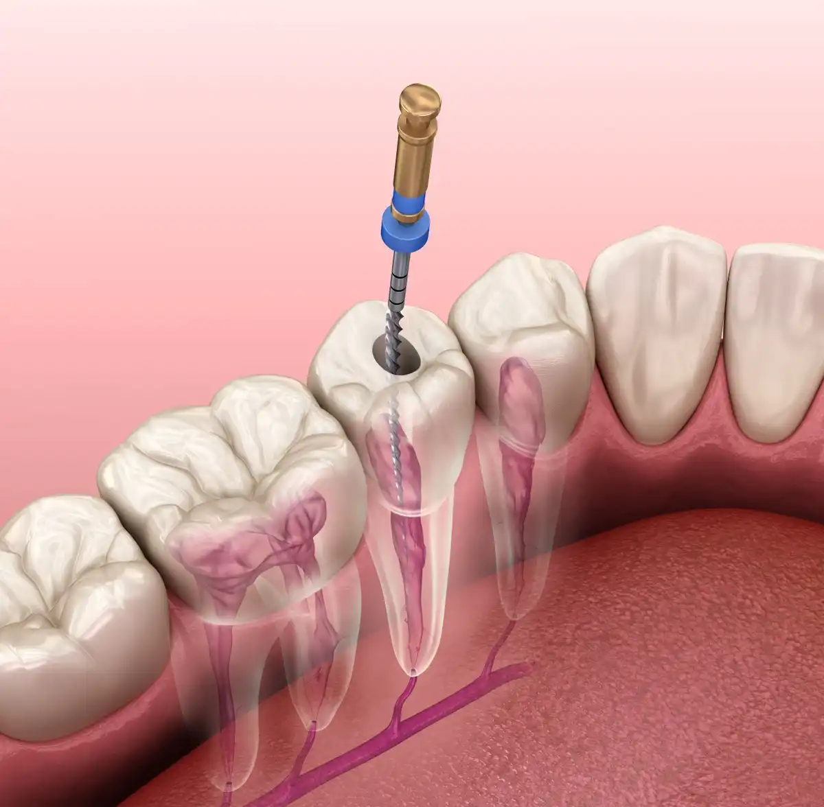 Root Canal Procedure: What to Expect, Step-By-Step & Cost