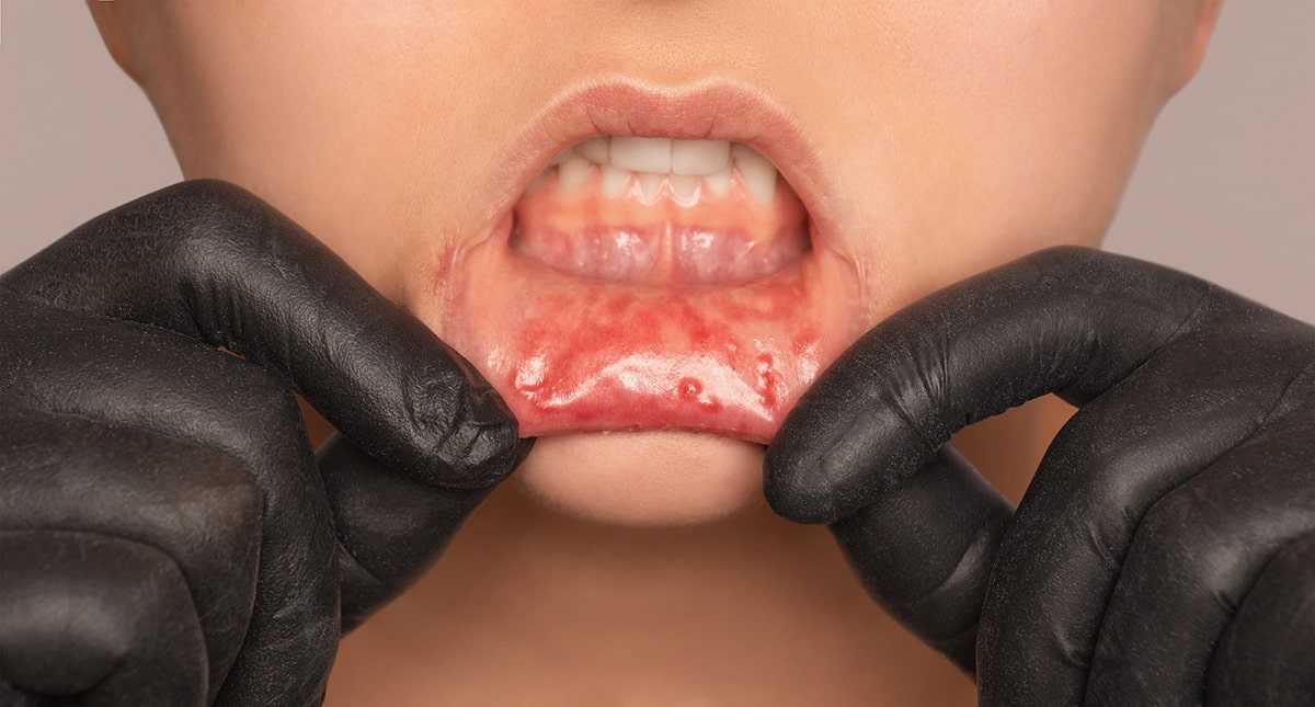 Managing Mouth Sores From Cancer and Dry Mouth Throughout Treatment article description 