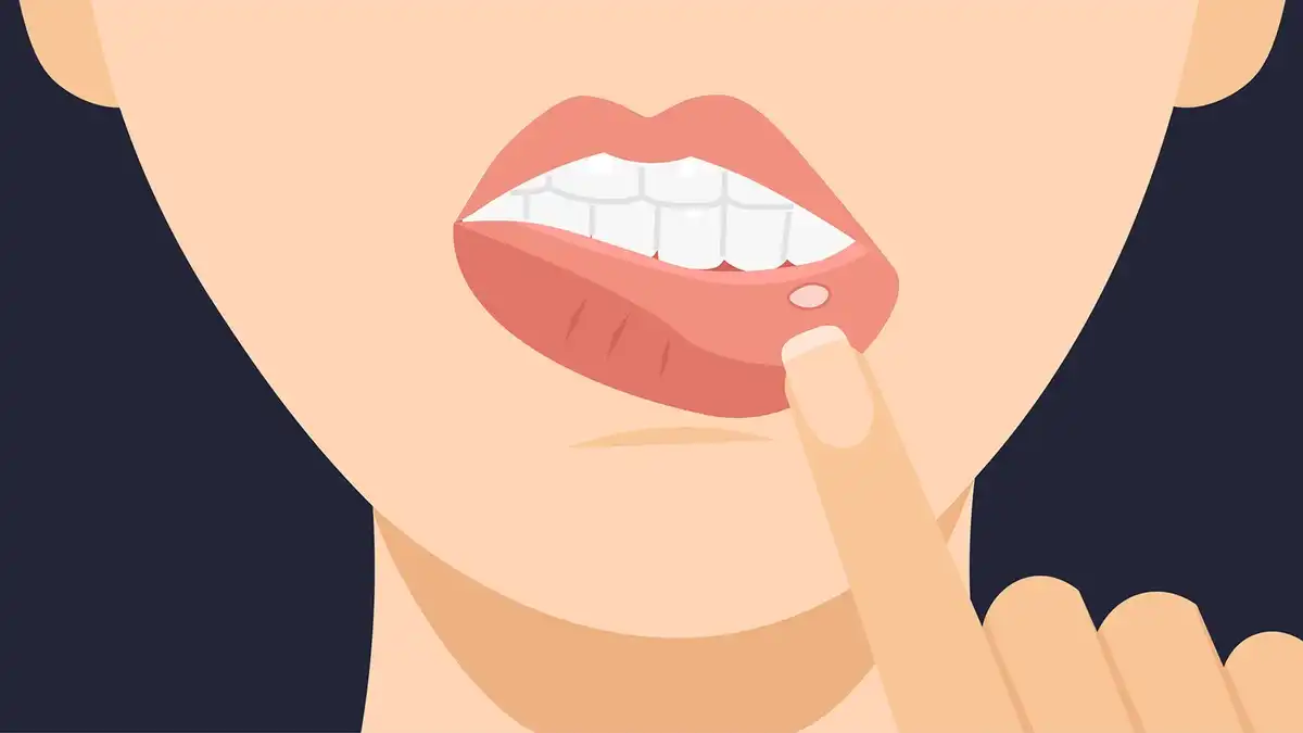 22 Remedies To Get Rid Of Your Canker Sore