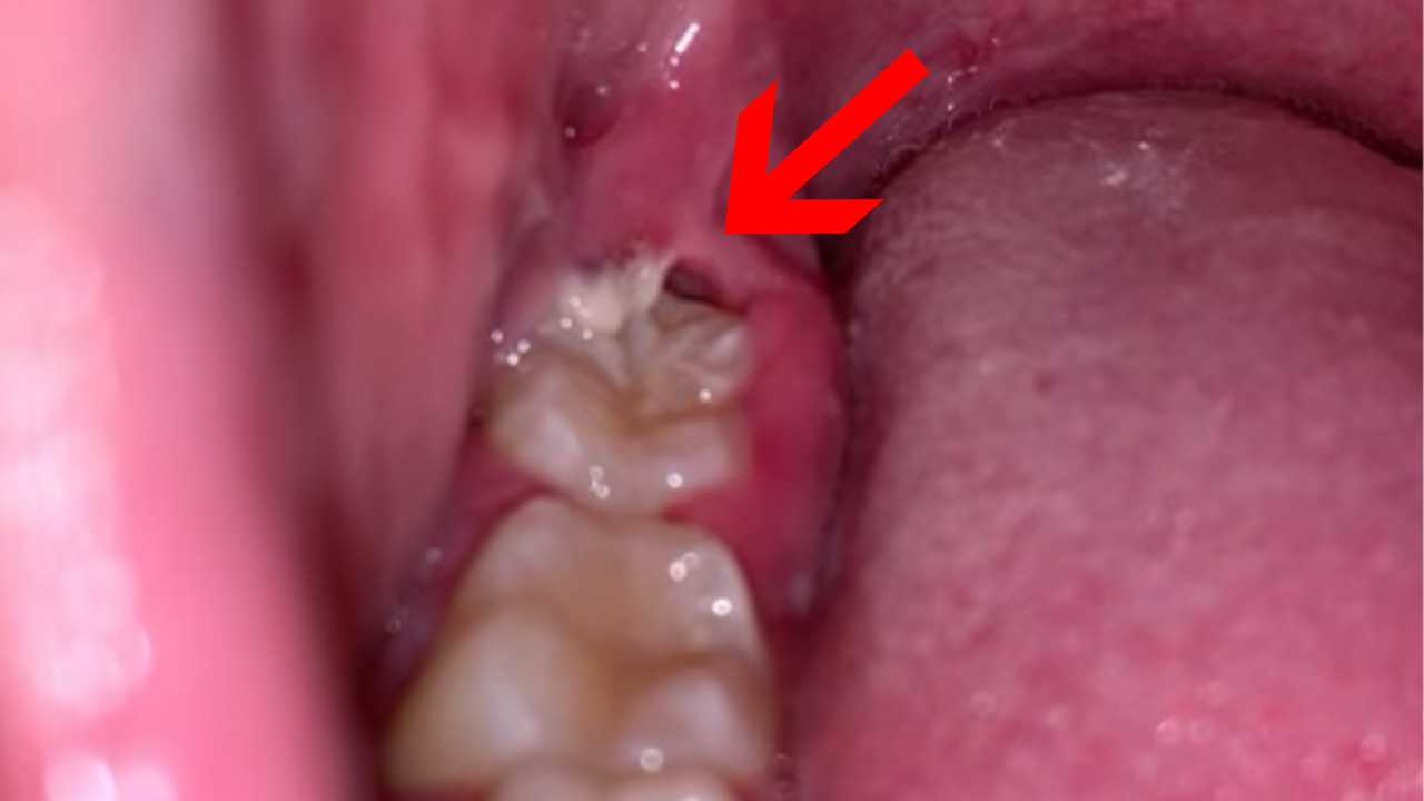 Pericoronitis: Swollen & Infected Wisdom Teeth