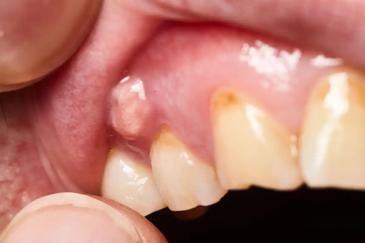 9 Reasons for a Boil or Bump on Gums