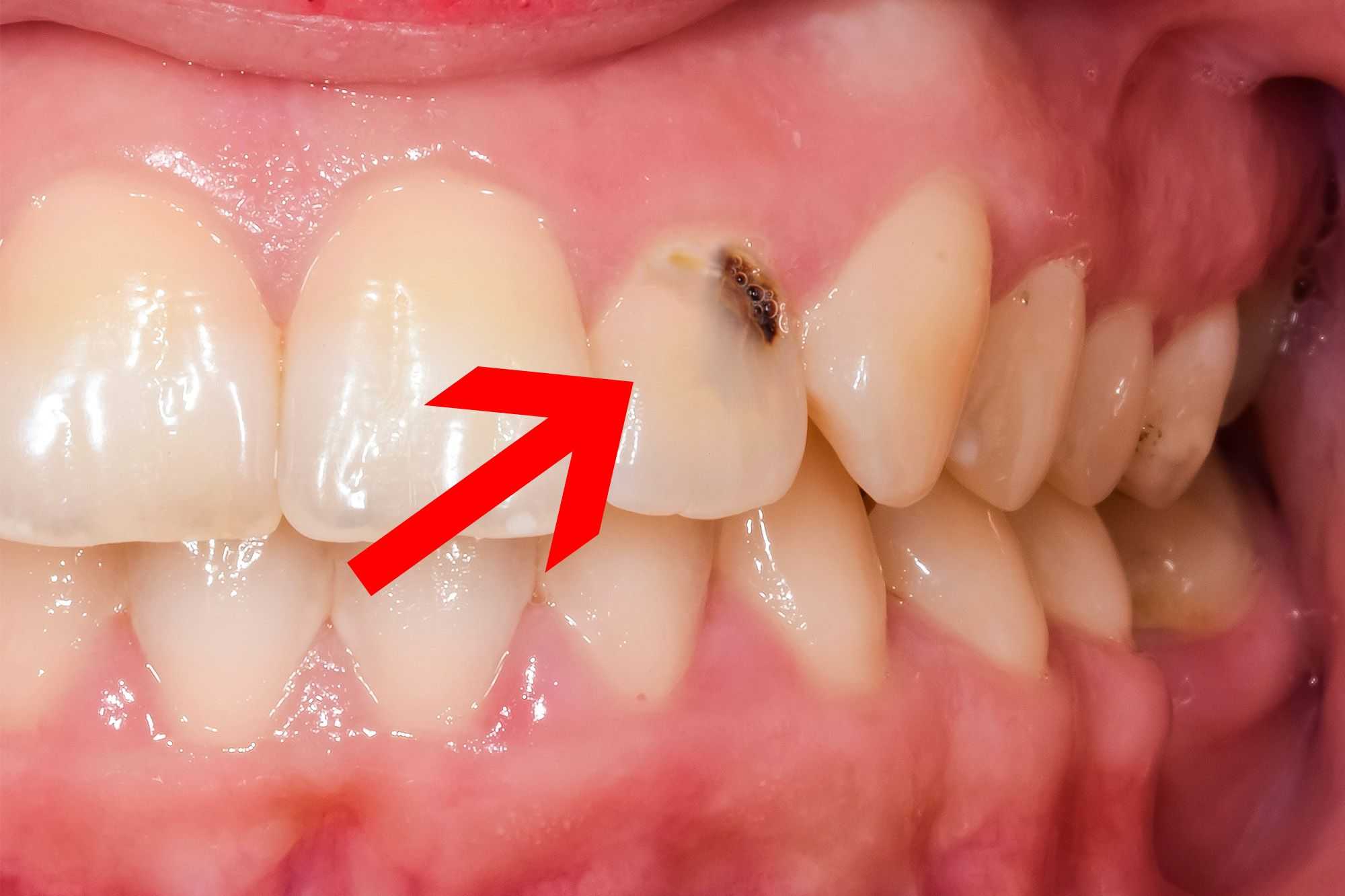 What Does A Cavity Look Like At Every Stage with Pictures 