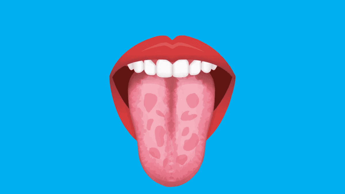 8 Reasons For Geographic Tongue & How To Treat It