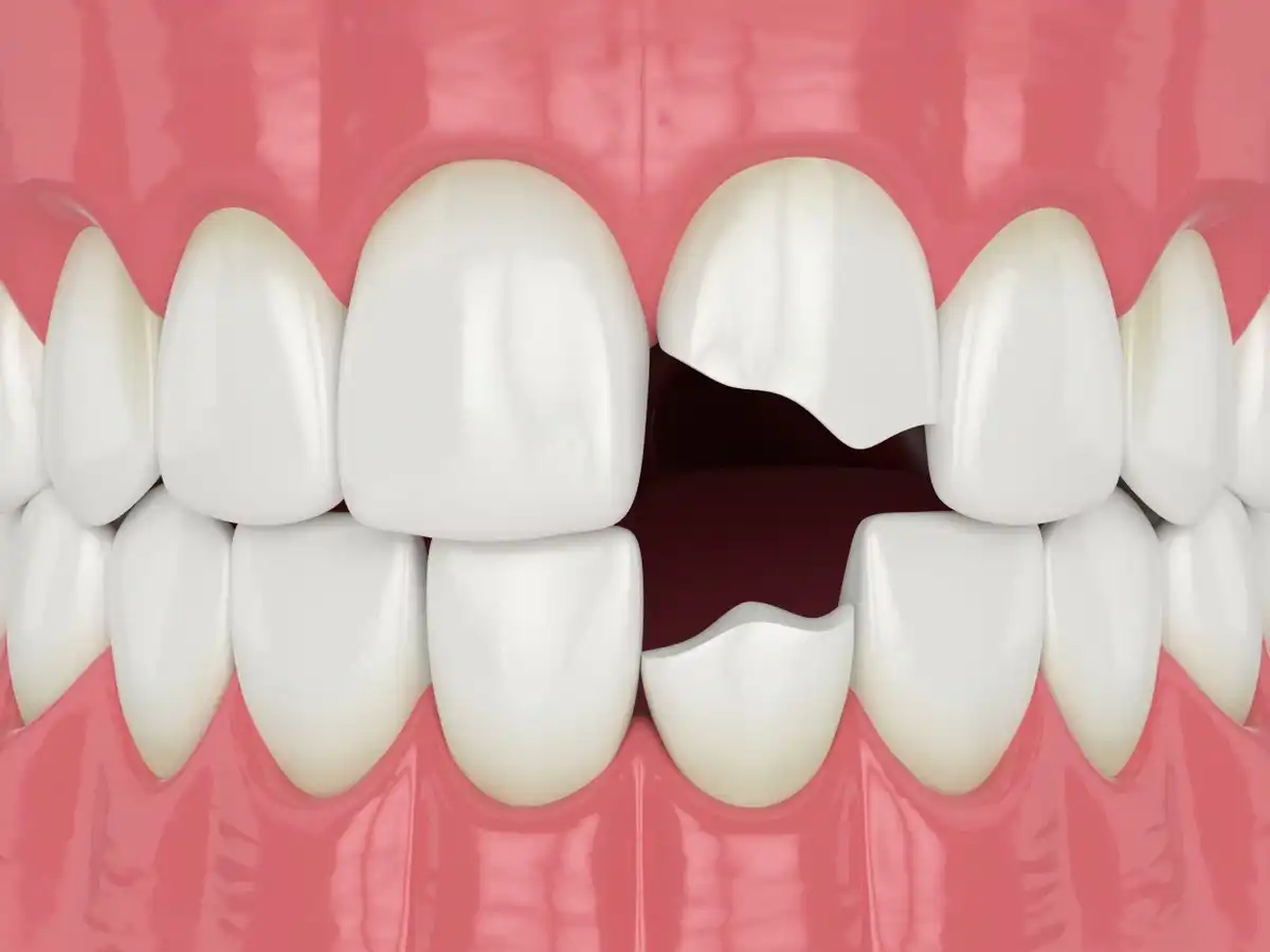 The Best Ways to Repair Broken Teeth