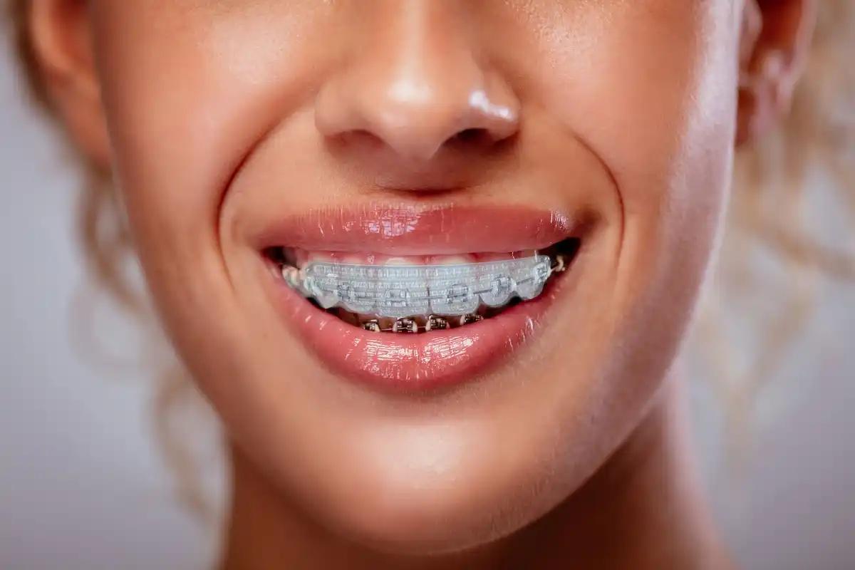 Teeth whitening instructions with clear orthodontic retainers